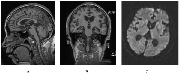 A person with inherited prion disease has cerebellar atrophy. This is highly susceptible for GSS.