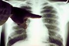 Amgen Drug Shrank 37% of Lung Cancer Tumors in Study