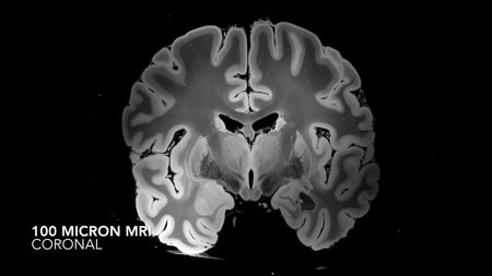 File:7 Tesla MRI of the ex vivo human brain at 100 micron resolution (axial, coronal, sagittal and descriptive summary).webm