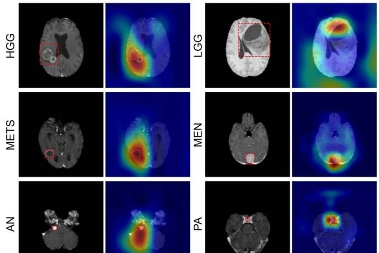 This shows brain scans