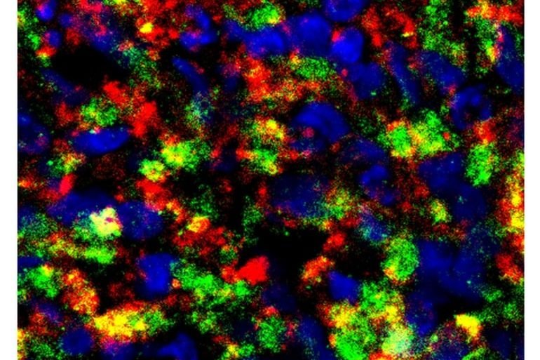 This shows amyloid beta in a staining sample