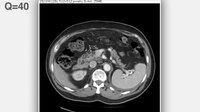 Fail:Continuously varied JPEG compression for an abdominal CT scan - 1471-2342-12-24-S1.ogv