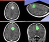 MeningiomaMRISegmentation.png