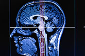 Addiction possibly linked to brain asymmetry - Photo: ©iStock/CasarsaGuru