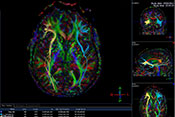 White matter damage could explain chronic headaches after TBI - Photo: ©iStock/wenht