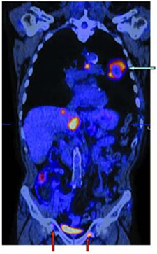 Scans used to diagnose lung cancer may not be accurate in areas with infectious lung disease