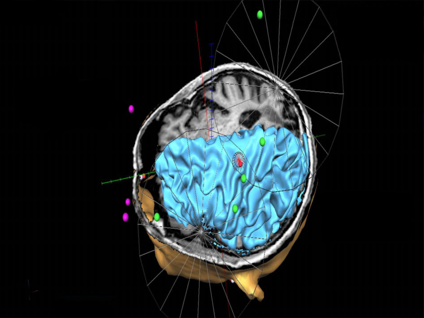 Study shows safety of brain stimulation together with exposure therapy for PTSD - Image courtesy of Dr. Albert Leung