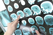 More studies needed on the effect of risk factors on multiple sclerosis - ©iStock/sudok1