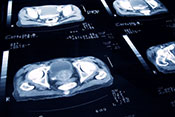 Apalutamide could delay metastasis of prostate cancer - Photo: ?iStock/jamesbenet