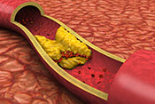 New cholesterol drug not cost-effective - Photo: ?iStock/jamesbenet