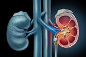 Process behind kidney stone formation - Image: ?iStock/wildpixel