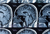 Long-term posttraumatic stress tied to changes in brain structure - Photo: ?iStock/Utah778