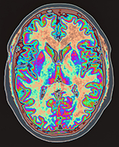 Modest brain changes seen in patients with schizophrenia after computer exercises - ©iStock/Image Source