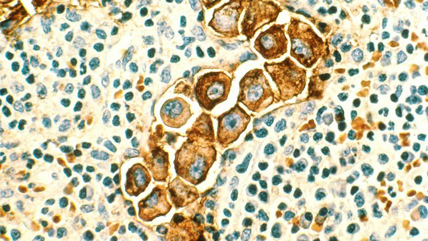 lymph nodes breast cancer under microscope 