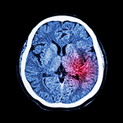 Neuroprotective compound may improve brain function after stroke - ?Stock/stockdevil