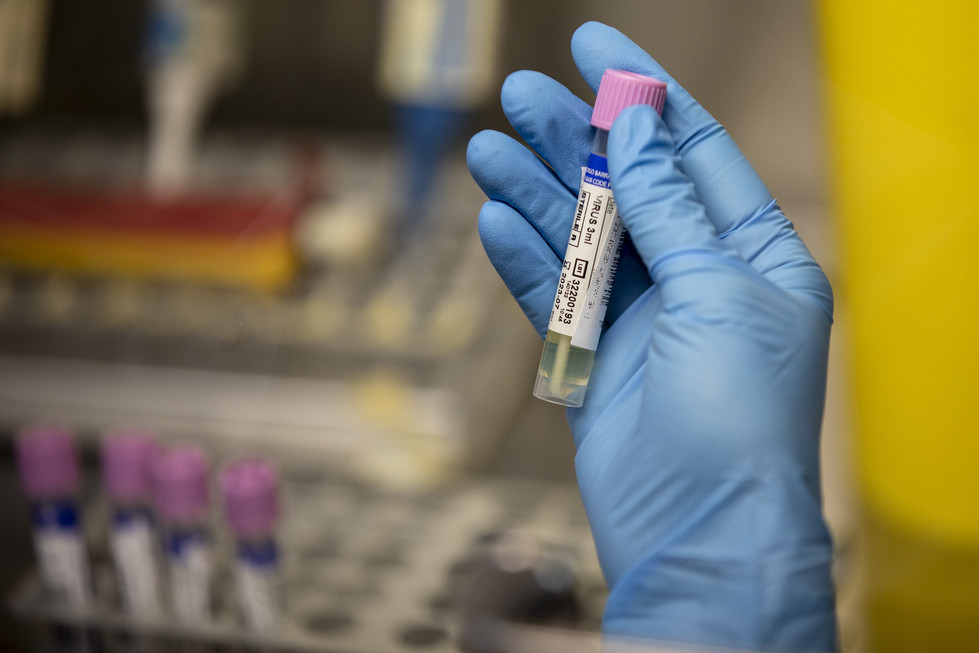 A medical laboratory technician shows a suspected monkeypox sample.