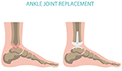 What Surgery Works Best for Advanced Ankle Arthritis?