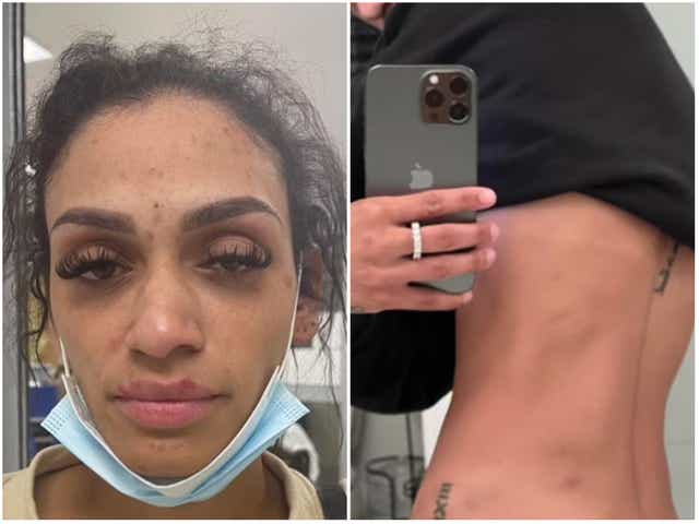 <p>Mychelle Johnson, wife of Miles Bridges, posted images of her injuries on social media </p>