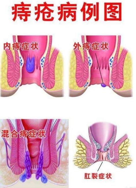 痔疮在哪个位置长什么样子图片 内痔外痔混合痔肉球脱出症状对照图片