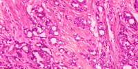 This 1974 microscope image made available by the Centers for Disease Control and Prevention shows changes in cells indicative of adenocarcinoma of the prostate.