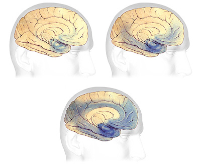 Three images of brains, one with a few tangles, another with moderate tangles, and another with extensive tangles.